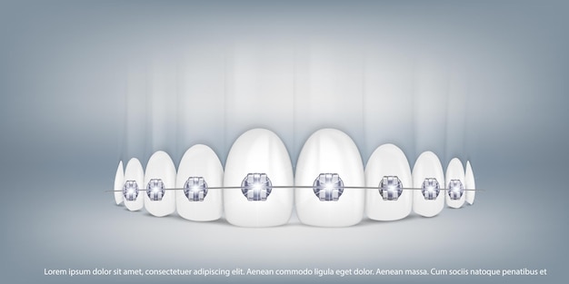 Vettore denti realistici dell'illustrazione di vettore 3d con la mascella superiore e inferiore delle parentesi graffe