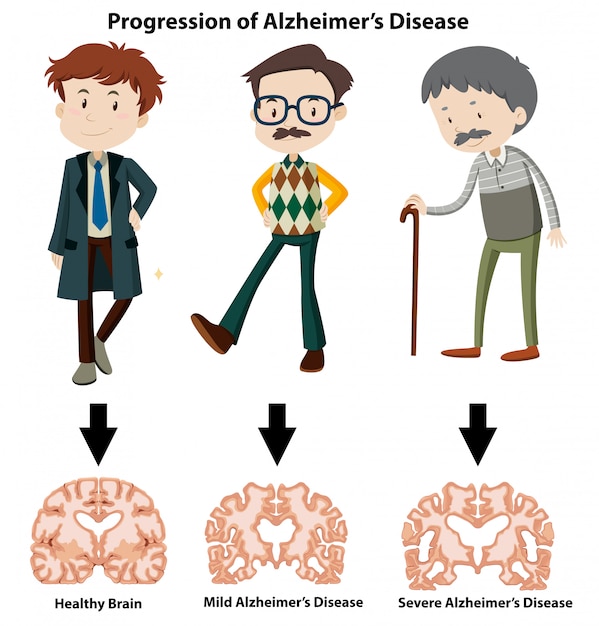 Вектор Прогресс болезни альцгеймера