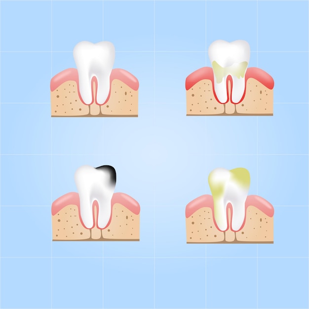 Вектор Набор зубов стоматологическая инфографика здоровый и больной зуб стоматолог десны