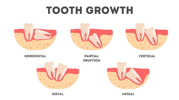 Aantal menselijke tanden in verschillende groeicondities. Tand groeit verkeerd. Idee van tandheelkundige gezondheid en medische behandeling. illustratie