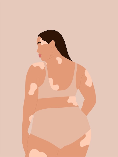 Abstract faceless woman with vitiligo in underwear Pigmentation dermatology disease concept