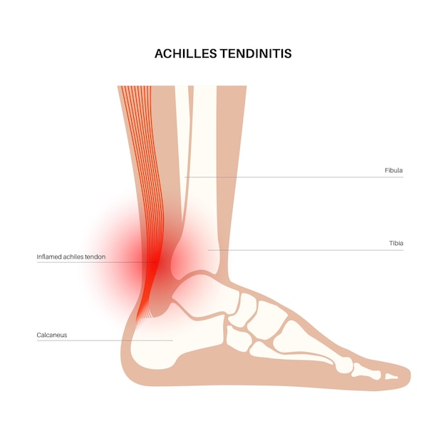 Achilles tendinitis anatomical poster. Ankle injury, ligament sprain, pain and tear problems