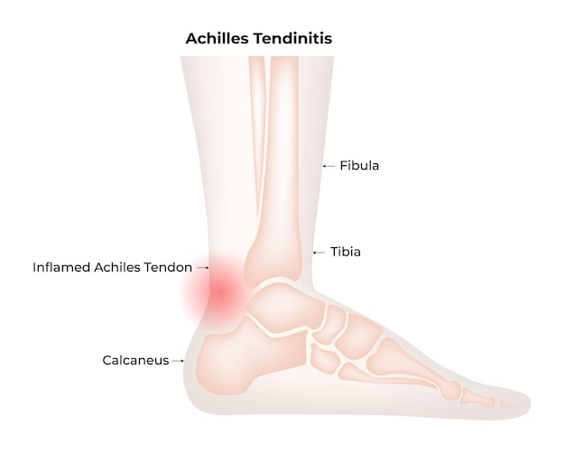 Vector achilles tendinitis fibula tibia inflamed achiles tendon calcaneus leg bone vector illustration