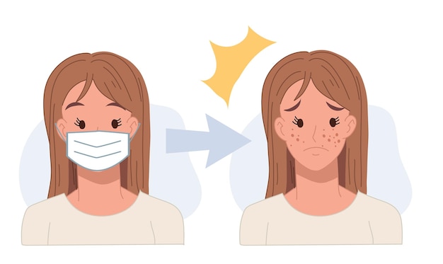 여드름은 얼굴 마스크를 쓰고 발생합니다.여드름 개념여드름 피부 문제 평면 벡터 만화 캐릭터 그림