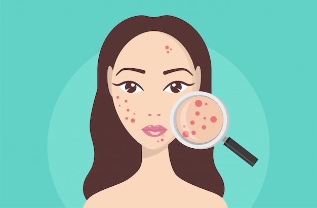 Acne, huidproblemen, stadia van acne. Het vergrootglas van de vrouwenholding voor het kijken cystic acne op haar gezichts.