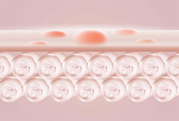 acne illustratie