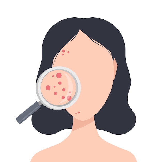 Acne skin medical examination of problem skin through a magnifying glass