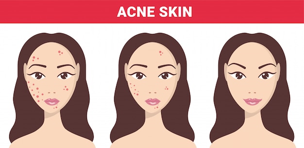 Vector acne, skin problems, stages of acne. acne skin of woman to clear steps