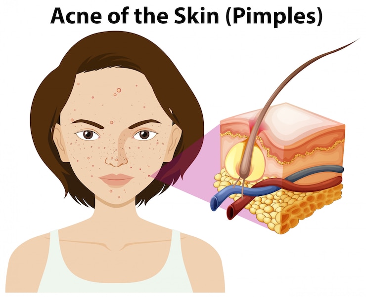 Vector acne of the skin on a woman