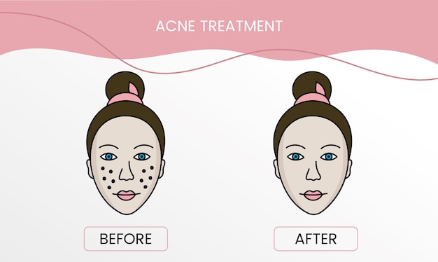 Acne treatment laser cosmetology before procedure and after applying treatment in vector Illustration of a woman with smooth clean skin and problematic skin