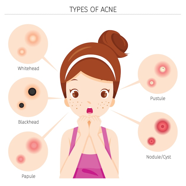 Vector acne types and girl with acne on her face