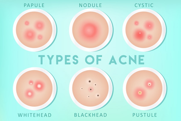 Vector acne types