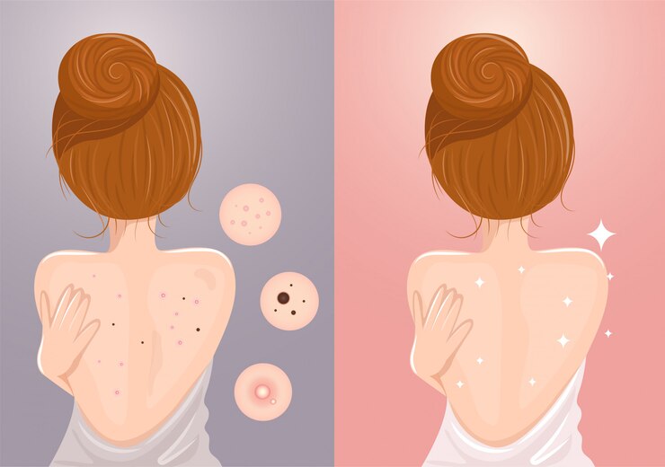 Acne veroorzaakt op de rug