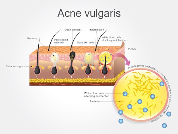 Vettore acne vulgaris