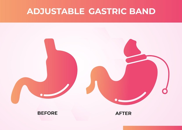 Adjustable gastric band devise weight loss surgery vector illustration