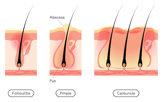 Afbeelding van huidproblemen ruwe huidacne vroege tot gevorderde folliculitis