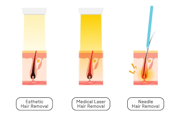 Afbeelding van ontharing Esthetische ontharing Medische laser ontharing Naald ontharing