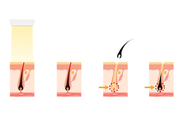 Vector afbeelding van ontharing het proces van ontharing na een esthetische ontharingsbehandeling