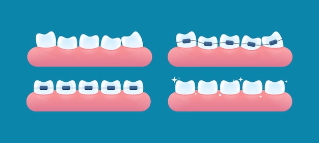 Vector alignment of teeth and bite correction with the help of braces system