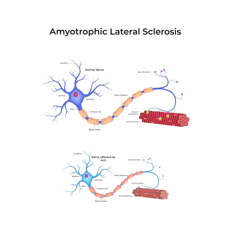 Vector amyotrophic lateral sclerosis als design vector illustration