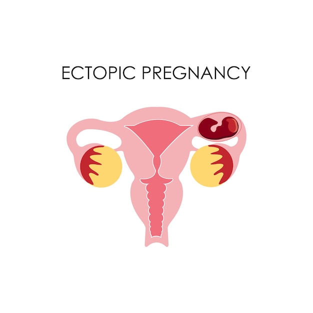 Anatomical drawing Ectopic pregnancy The female uterus