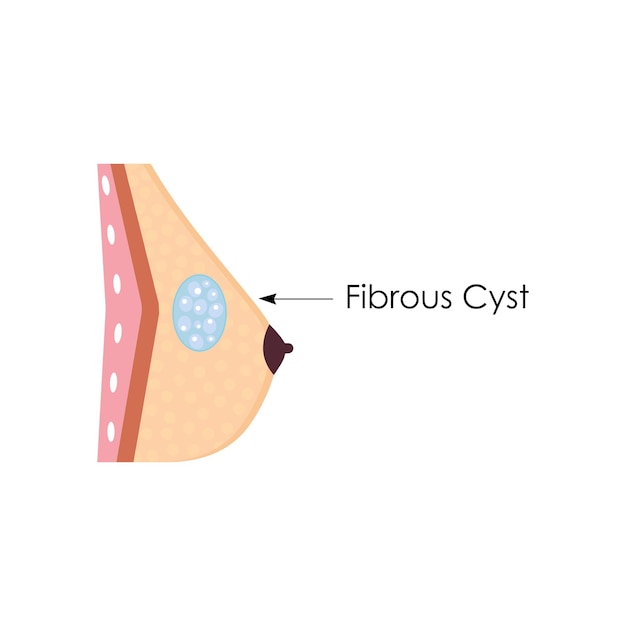 Anatomical drawing Female breast with fibrous cyst