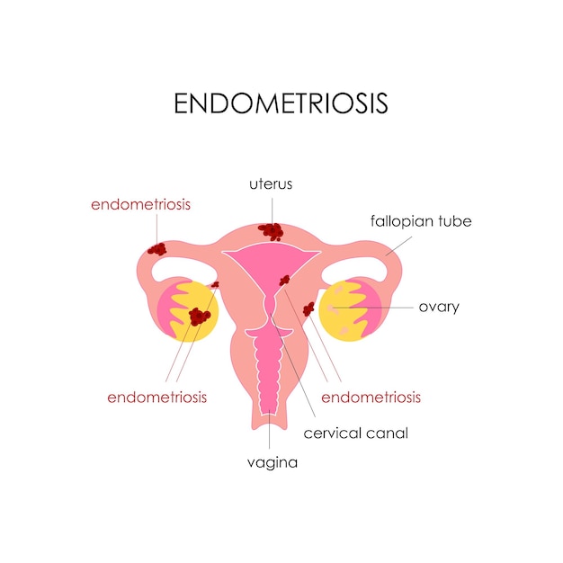 Anatomical drawing Uterus with endometriosis Description of the structure of the uterus