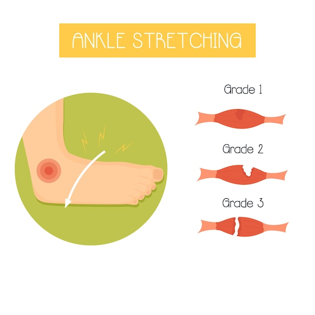 Анатомическая векторная иллюстрация в плоском стиле растяжения щиколотки и его степеней. спортивные травмы