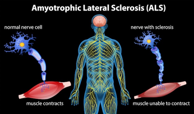 Vector anatomie van amyotrofische laterale sclerose