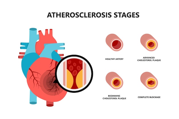 Anatomie van het menselijk hart met atherosclerotische plaque cholesterolplaque in de bloedvaten