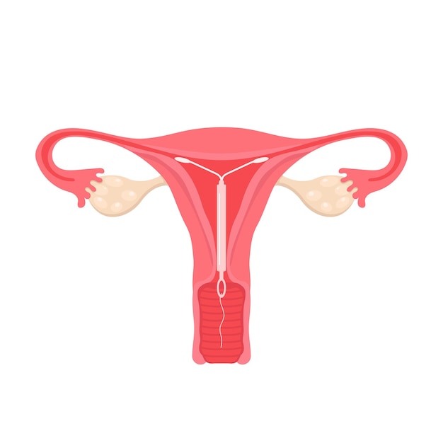 女性の生殖器系の解剖学女性の避妊子宮コイルの位置