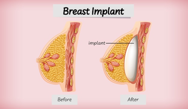 인간 유방 임플란트의 해부학