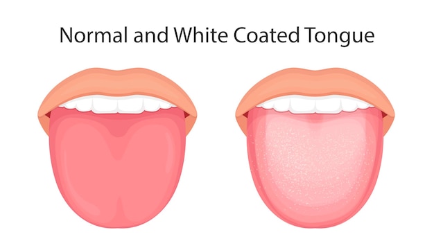 Анатомия полости рта векторная иллюстрация языка с белым налетом