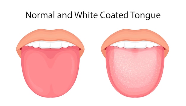Anatomy of the oral cavity Vector illustration of tongue with white coating