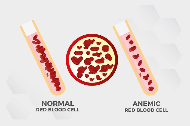 Vettore anemia illustrazione medica del vettore medico dei globuli rossi del ferro medico.