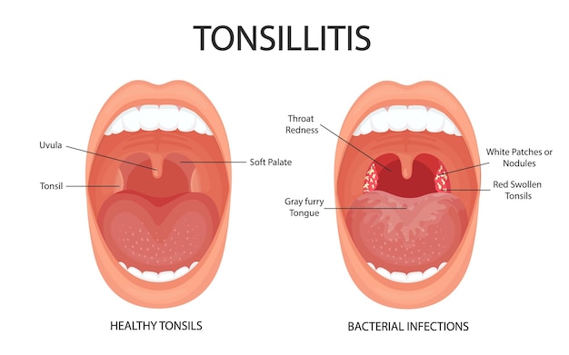 Angina faryngitis en tonsillitis Tonsillitis is een bacteriële tonsilinfectie Open mond anatomie