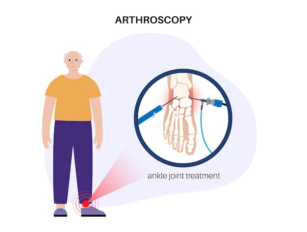 Ankle arthroscopy poster