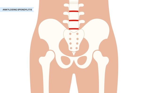 Ankylosing spondylitis Arthritis that causes inflammation in the joints and ligaments of the spine Inflamed and fusion vertebrae in the spinal column Hip and lower back pain vector illustration