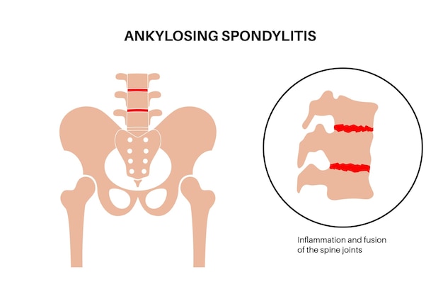 Vector ankylosing spondylitis arthritis that causes inflammation in the joints and ligaments of the spine inflamed and fusion vertebrae in the spinal column hip and lower back pain vector illustration