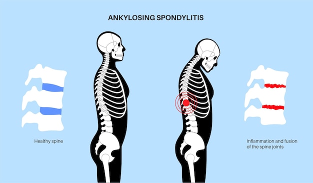 Ankylosing spondylitis Arthritis that causes inflammation in the joints and ligaments of the spine Inflamed and fusion vertebrae in the spinal column Hip and lower back pain vector illustration