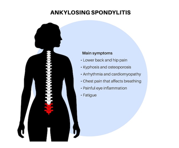 Vector ankylosing spondylitis arthritis that causes inflammation in the joints and ligaments of the spine inflamed and fusion vertebrae in the spinal column hip and lower back pain vector illustration