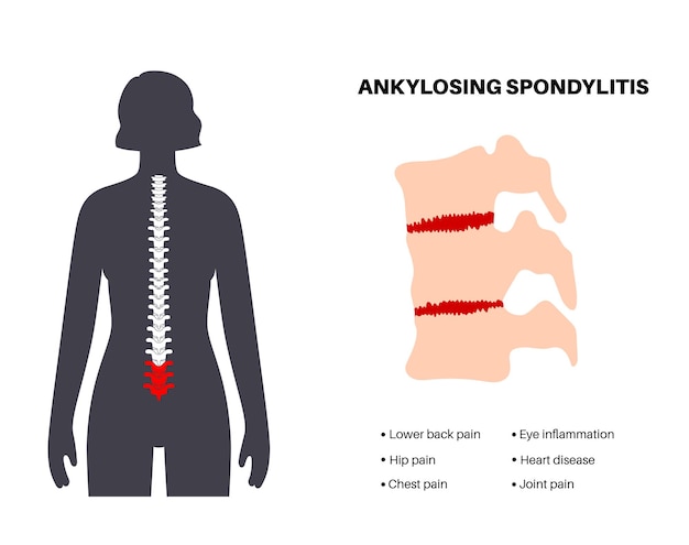 Vector ankylosing spondylitis arthritis that causes inflammation in the joints and ligaments of the spine inflamed and fusion vertebrae in the spinal column hip and lower back pain vector illustration