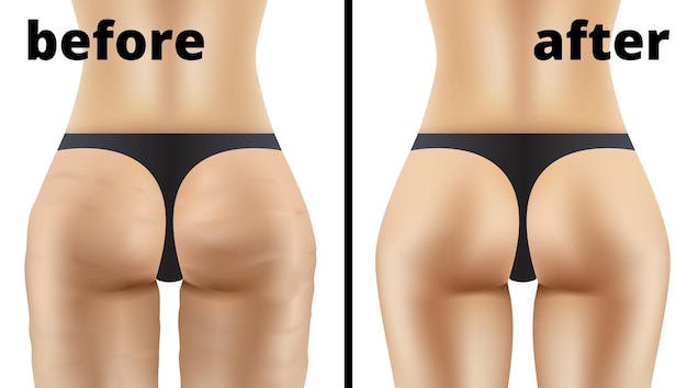 Anticellulite ass massage before and after illustration