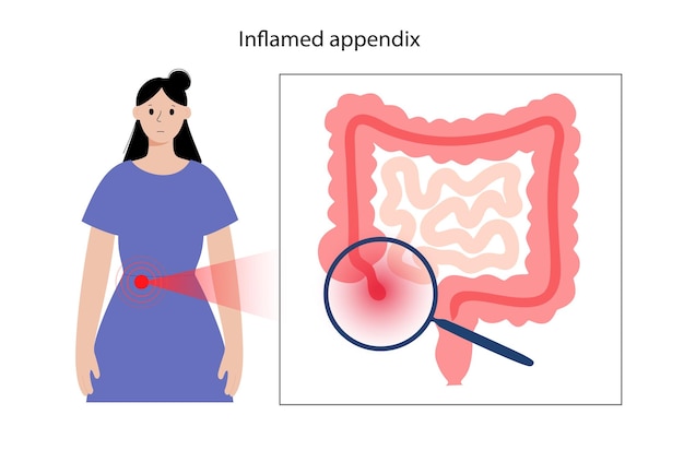 Appendix pain concept