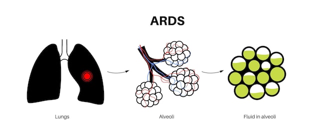 벡터 ards 해부학 포스터