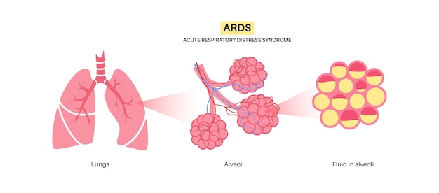 Vettore poster anatomico ards