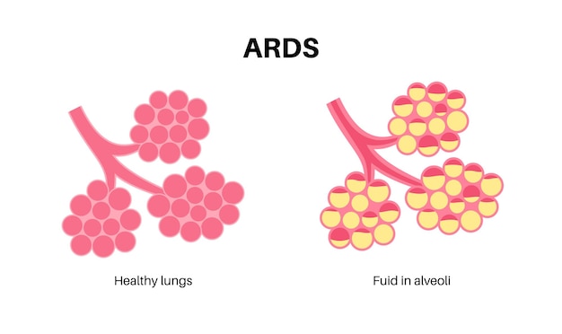 ARDS anatomische poster