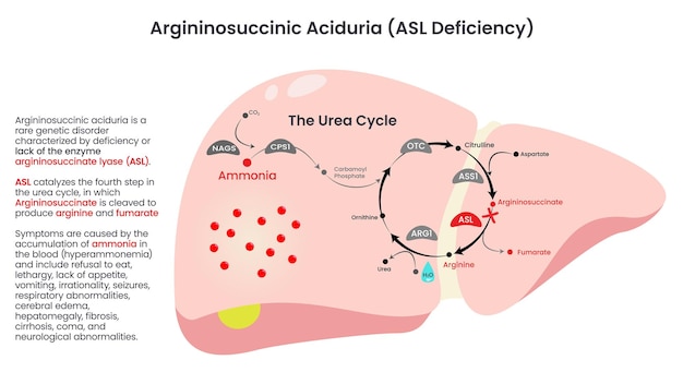 Vector argininosuccinic aciduria asl deficiency vector diagram