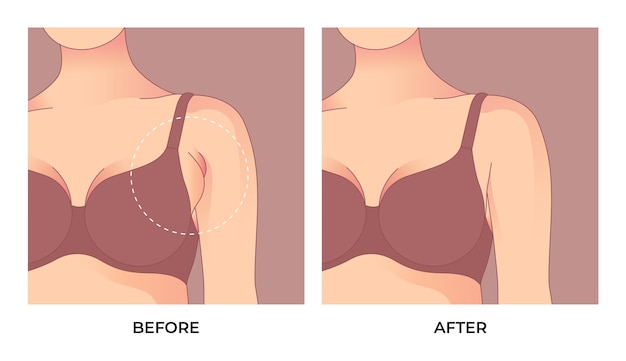 Premium Vector  Armpit fat before and after brachioplasty, liposuction or  plastic surgery, woman body shape transfo