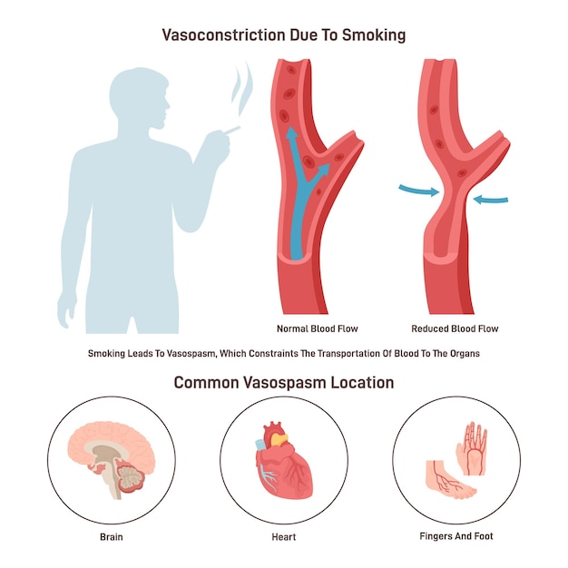 Arteriële vasoconstrictie Normale en vernauwde bloedvaten